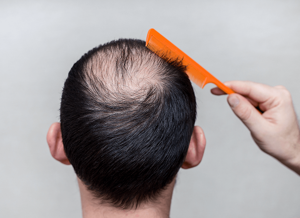 How All-Natural PRP Therapy Reverses Thinning Hair - Erasing Time